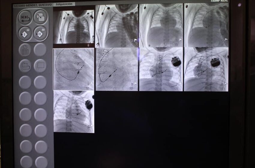  Implantación de Marcapaso Definitivo Endocárdico