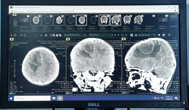  Neurocirujanos del Issste logran retirar absceso cerebral extenso a niña de tres año